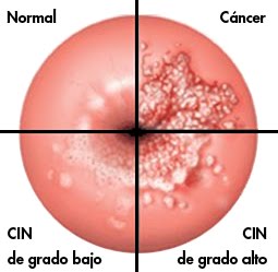 cancer 1